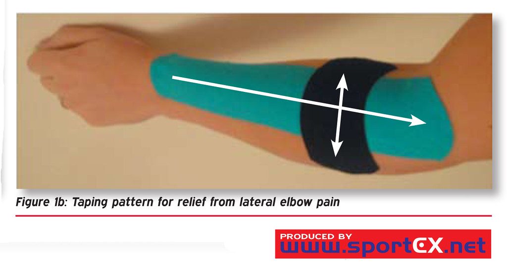 Taping pattern for relief from lateral elbow pain